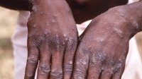 Variole du singe : la flambée reste « maîtrisable », selon l’OMS
