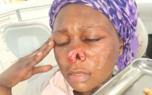 Lastourville&nbsp;: Une gabonaise perd une grosse partie de son nez lors d’une bagarre avec son copain